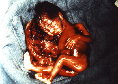 abortion pictures | mouade agafay